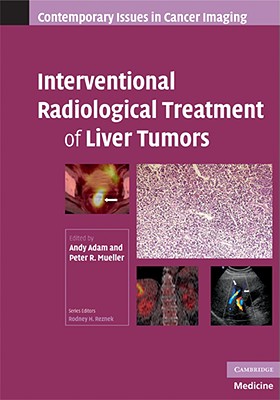 Interventional Radiological Treatment of Liver Tumors