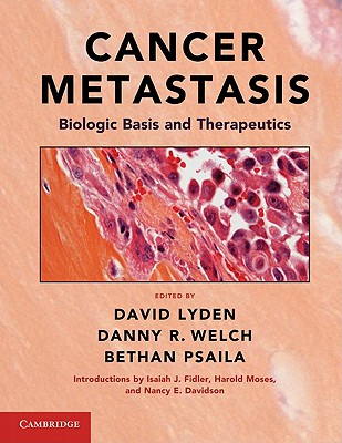 Cancer Metastasis