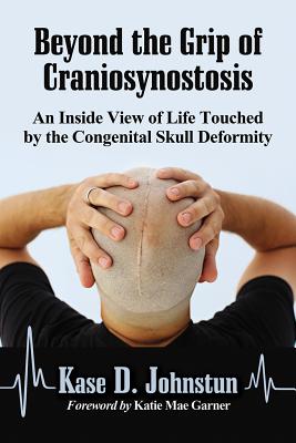 Beyond the Grip of Craniosynostosis