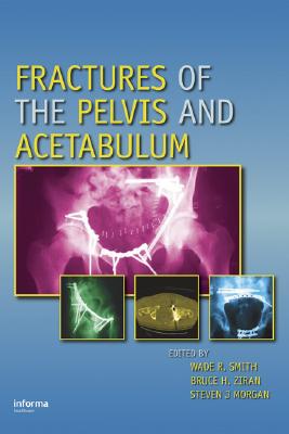 Fractures of the Pelvis and Acetabulum