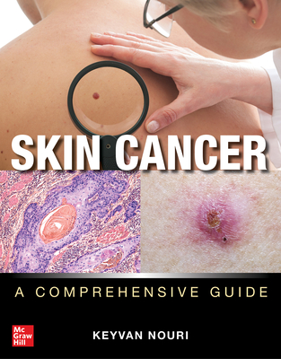 Skin Cancer: A Comprehensive Guide