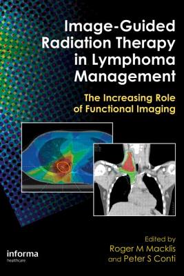 Image-Guided Radiation Therapy in Lymphoma Management