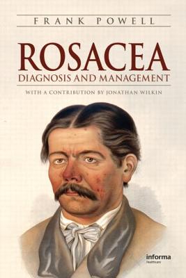 Rosacea