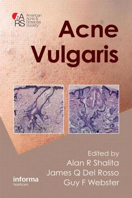 Acne Vulgaris