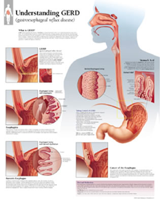 Understanding GERD (Gastroesophageal Reflux Disease) Laminated Poster