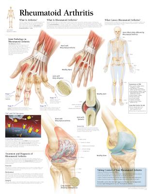 Rheumatoid Arthritis Paper Poster