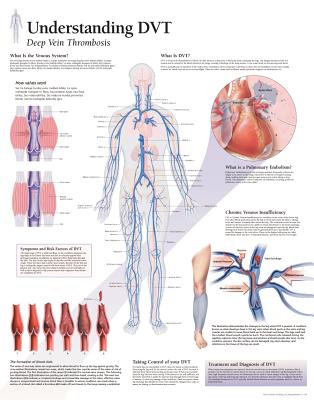 Understanding DVT Paper Poster