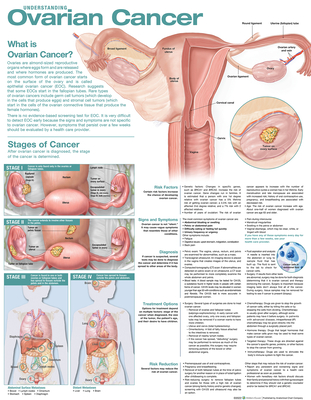 Understanding Ovarian Cancer Anatomical Chart