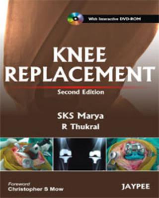 Knee Replacement