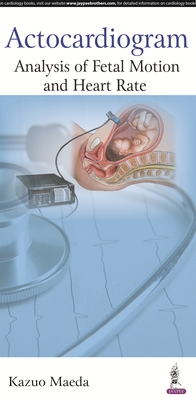 Actocardiogram