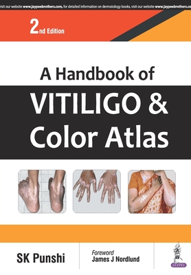 A Handbook of Vitiligo & Color Atlas