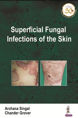 Superficial Fungal Infections of the Skin