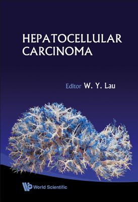 Hepatocellular Carcinoma